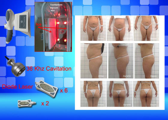 Cryo, das Ausrüstungs-Gewicht Lasers Lipo einfriert, verlieren Hauptschönheits-Maschine